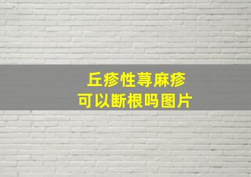 丘疹性荨麻疹可以断根吗图片