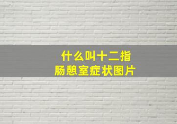 什么叫十二指肠憩室症状图片