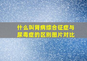 什么叫肾病综合征症与尿毒症的区别图片对比