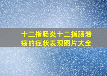 十二指肠炎十二指肠溃疡的症状表现图片大全