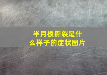 半月板撕裂是什么样子的症状图片