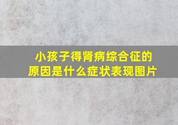 小孩子得肾病综合征的原因是什么症状表现图片