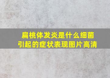 扁桃体发炎是什么细菌引起的症状表现图片高清