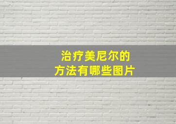 治疗美尼尔的方法有哪些图片