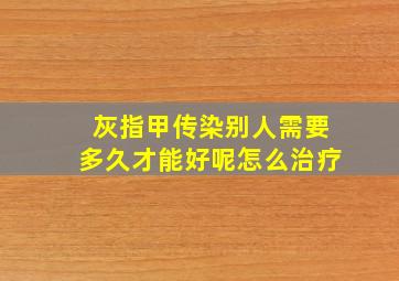 灰指甲传染别人需要多久才能好呢怎么治疗