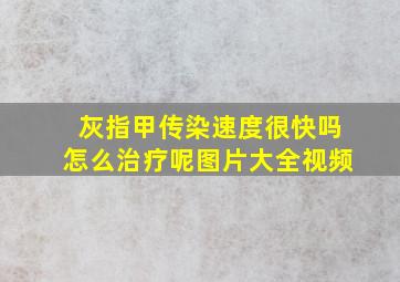 灰指甲传染速度很快吗怎么治疗呢图片大全视频