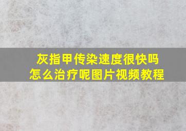 灰指甲传染速度很快吗怎么治疗呢图片视频教程