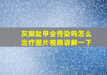 灰脚趾甲会传染吗怎么治疗图片视频讲解一下