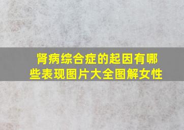 肾病综合症的起因有哪些表现图片大全图解女性