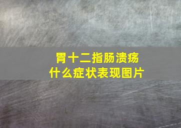 胃十二指肠溃疡什么症状表现图片