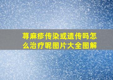 荨麻疹传染或遗传吗怎么治疗呢图片大全图解