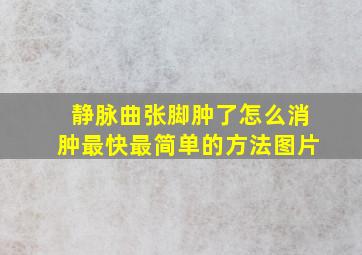 静脉曲张脚肿了怎么消肿最快最简单的方法图片