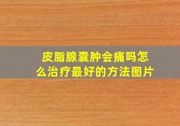 皮脂腺囊肿会痛吗怎么治疗最好的方法图片