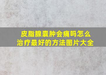 皮脂腺囊肿会痛吗怎么治疗最好的方法图片大全