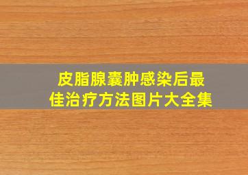 皮脂腺囊肿感染后最佳治疗方法图片大全集