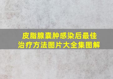 皮脂腺囊肿感染后最佳治疗方法图片大全集图解