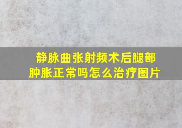 静脉曲张射频术后腿部肿胀正常吗怎么治疗图片