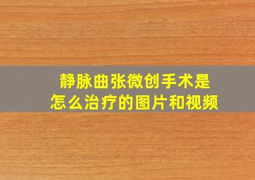 静脉曲张微创手术是怎么治疗的图片和视频