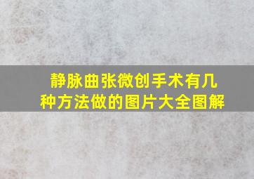 静脉曲张微创手术有几种方法做的图片大全图解