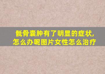 骶骨囊肿有了明显的症状,怎么办呢图片女性怎么治疗